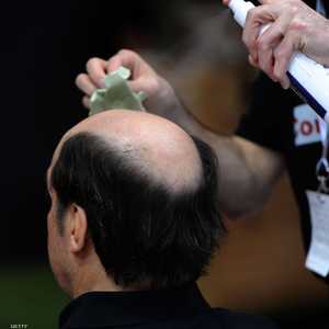 الصلع مشكلة تؤرق الملايين