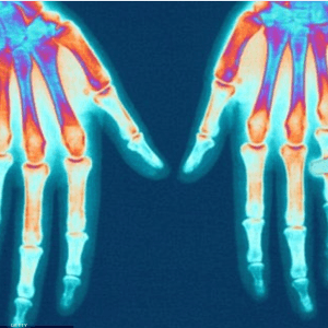 المرضى المصابون بالتهاب المفاصل يواجهون قلة في المرونة وتورما في المفاصل