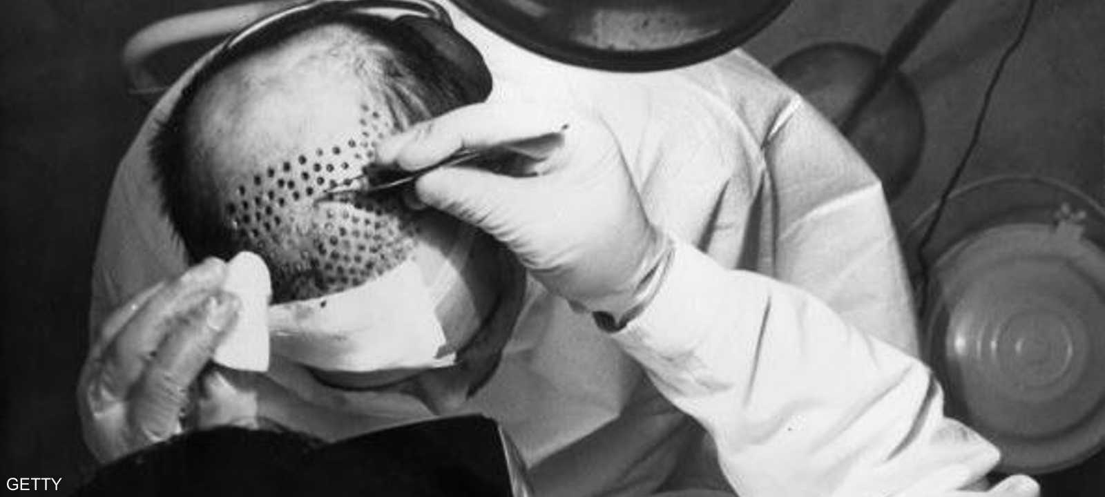 زراعة الشعر سياحة مربحة في تركيا