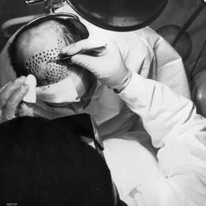 زراعة الشعر سياحة مربحة في تركيا