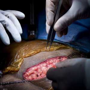 الجراحات تعد أضخم عملية زراعة كلى يشهدها المركز الطبي