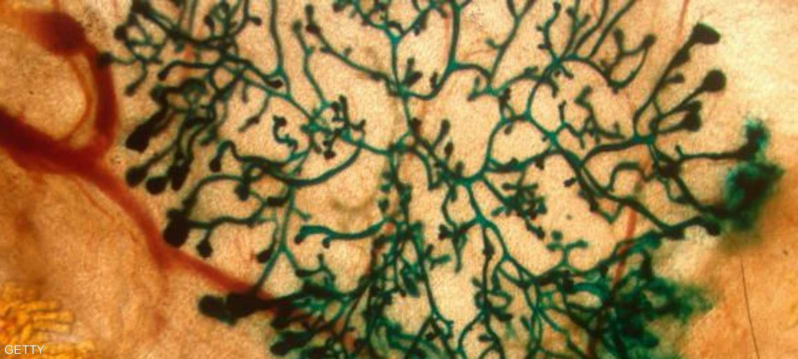 دراسة استخدام الليزر في علاج المصابين بسرطان المخ تمر حاليا بمراحلها الأولية.