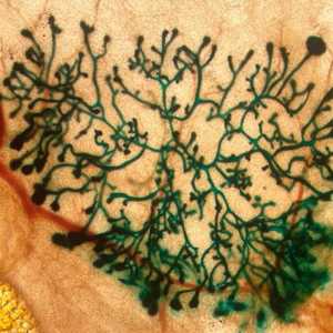 دراسة استخدام الليزر في علاج المصابين بسرطان المخ تمر حاليا بمراحلها الأولية.