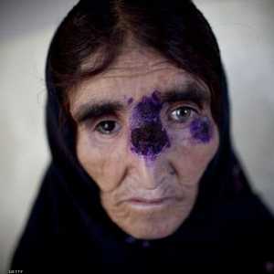 سيدة أفغانية مصابة بالمرض