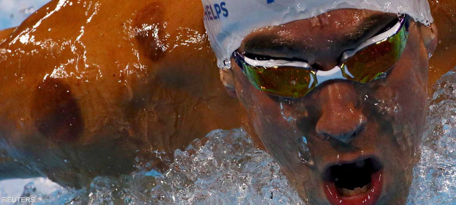 البقع الداكنة على كتفي فيليبس تعود إلى استخدام  الحجامة