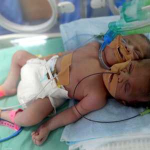 التومأن هما بنتان وقد تفاجأ الأطباء بأنهما سياميان.