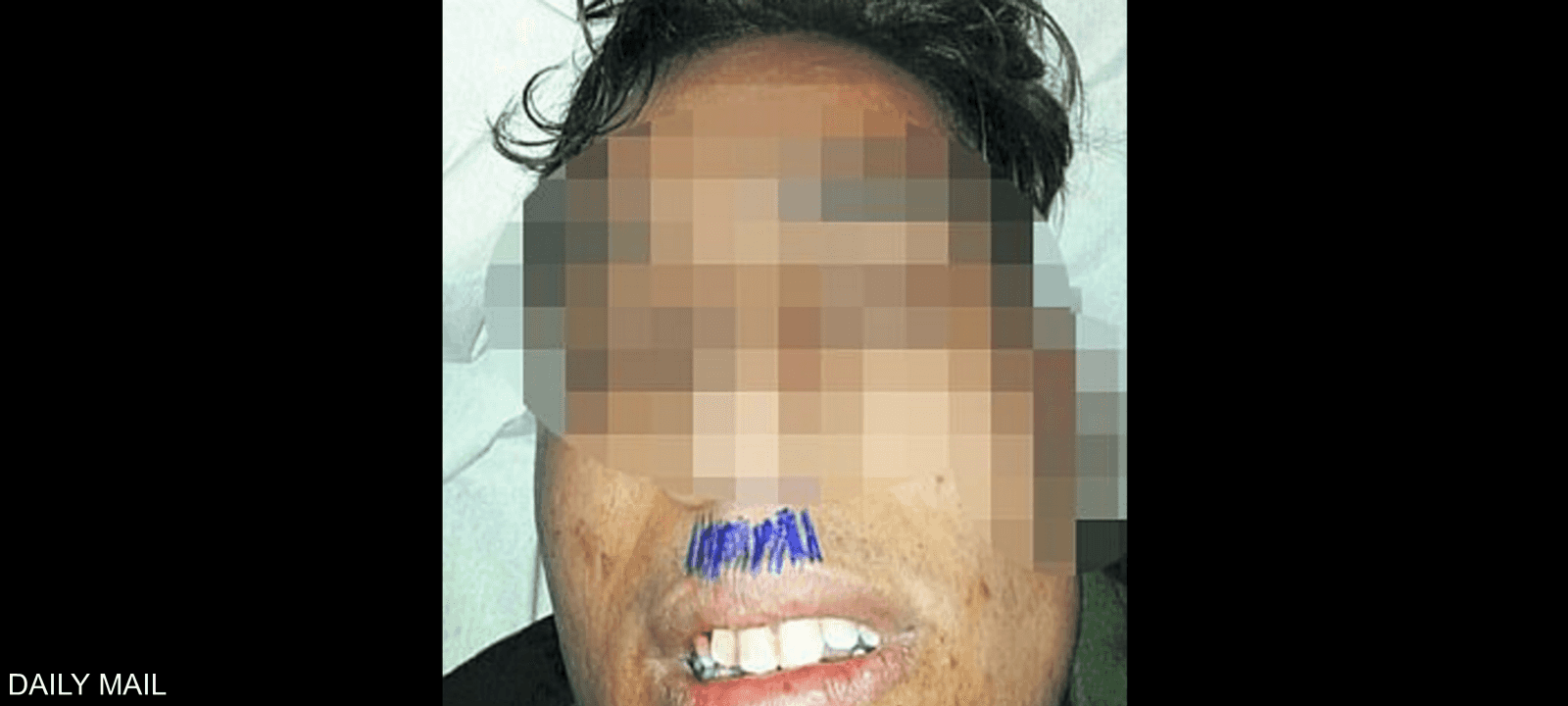 يظهر اللاجئ وقد رسم المسعف على وجهه شنبا "نازيا"