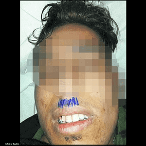 يظهر اللاجئ وقد رسم المسعف على وجهه شنبا "نازيا"