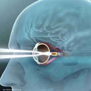 اختبار رقاقة تعيد البصر للمكفوفين في فرنسا