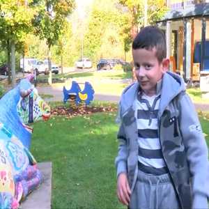 زراعة جلد لإنقاذ حياة طفل