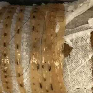 الدودة التي سحبت من جسم المريض