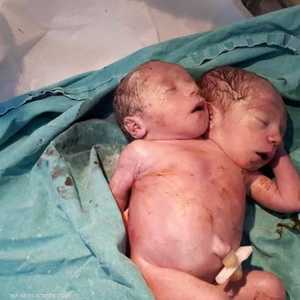 الجنين الذي ولد برأسين