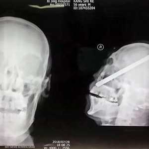 صورة أشعة مقطعية تظهر القضيب في رأس العامل