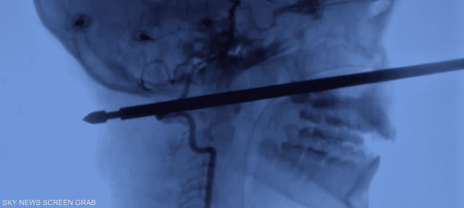 صورة أشعة للحادثة