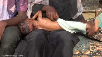 اليمن.. المجاعة تتسب بأسوأ أزمة إنسانية في العالم