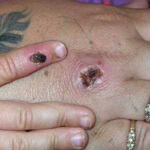 أعراض المرض تتمثل بظهور طفح جلدي وحمى