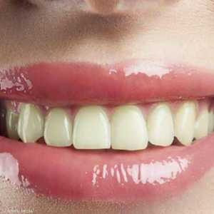 تسوس الأسنان يستوجب استشارة الطبيب قبل التبييض