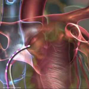 تصلب الشرايين مشكلة صحية يعاني منها الملايين في العالم.