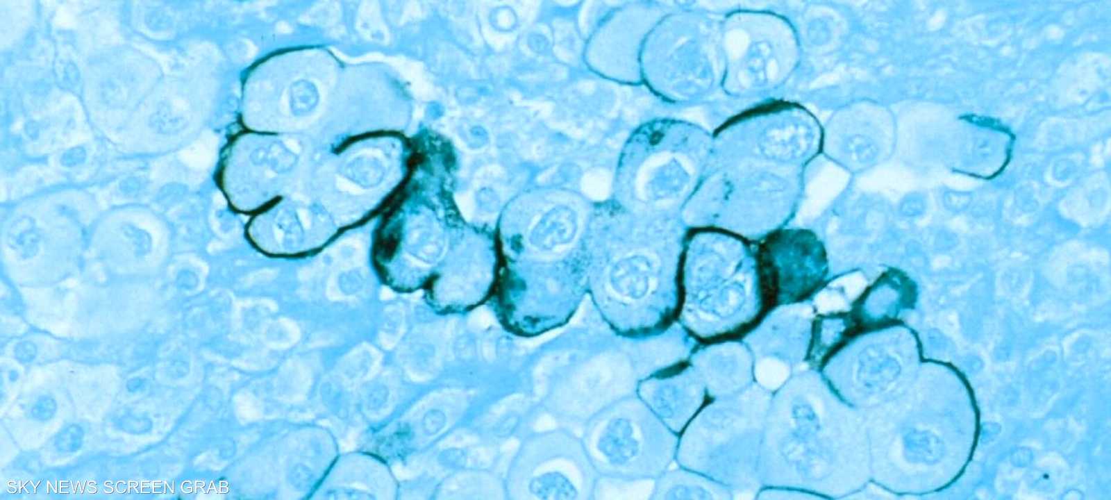خوارزمية ذكاء اصطناعي لتشخيص سرطان البنكرياس