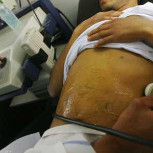 أعراض سرطان الكبد تختلط مع أعراض أمراض أخرى