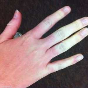 يصبح لون الجلد أبيض بفعل مرض الرينود