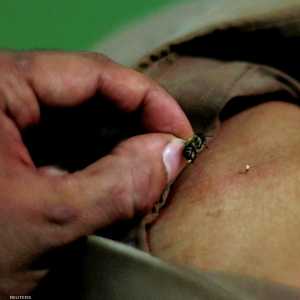 لا يوجد دليل علمي على فوائد العلاج بلسع النحل