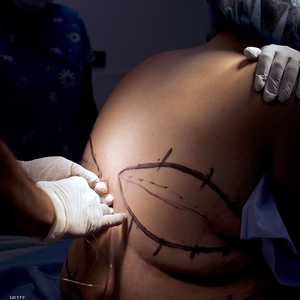 الدراسة تقول: عمليات جراحة السمنة تؤثر على العلاقات الشخصية