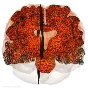 تجريب لقاح جديد لعلاج ألزهايمر