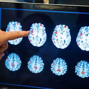 بيّنت تجربة سريرية أن دونانيماب يبطئ تطور هذا المرض