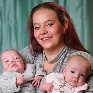 أيام فصلت ولادة الطفلين