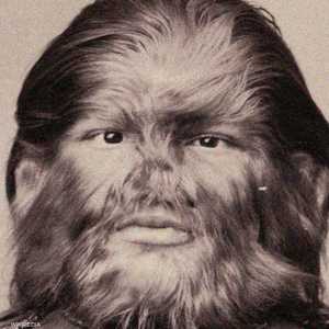 لا يوجد علاج للمصابين بمتلازمة الذئب. تعبيرية