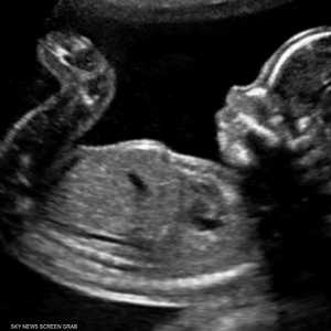 الجنين يقوم بأمور غريبة في بطن أمه