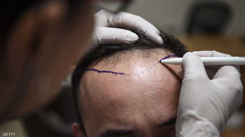 وفاة شخص في عملية زراعة شعر تحير الأطباء | سكاي نيوز عربية