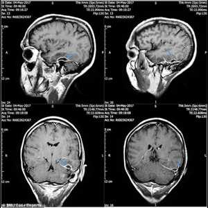 مسح لموقع الالتهاب في جمجمة الرجل