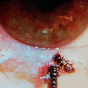 الشابة عانت انتفاخا في الجفن السفلي