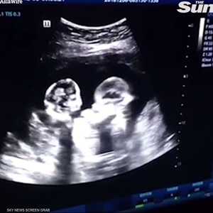 ملاكمة بين توأمين في رحم أمهما