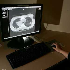 ارتفاع في عدد الإصابات بسرطان الرئة بين غير المدخنين