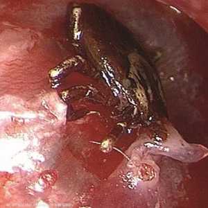 صورة لأذن الصبي من الداخل حيث تظهر الحشرة الضارة