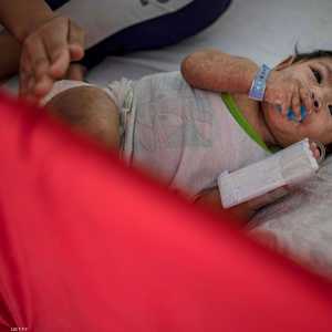 انتشار الحصبة يتسع في الولايات المتحدة