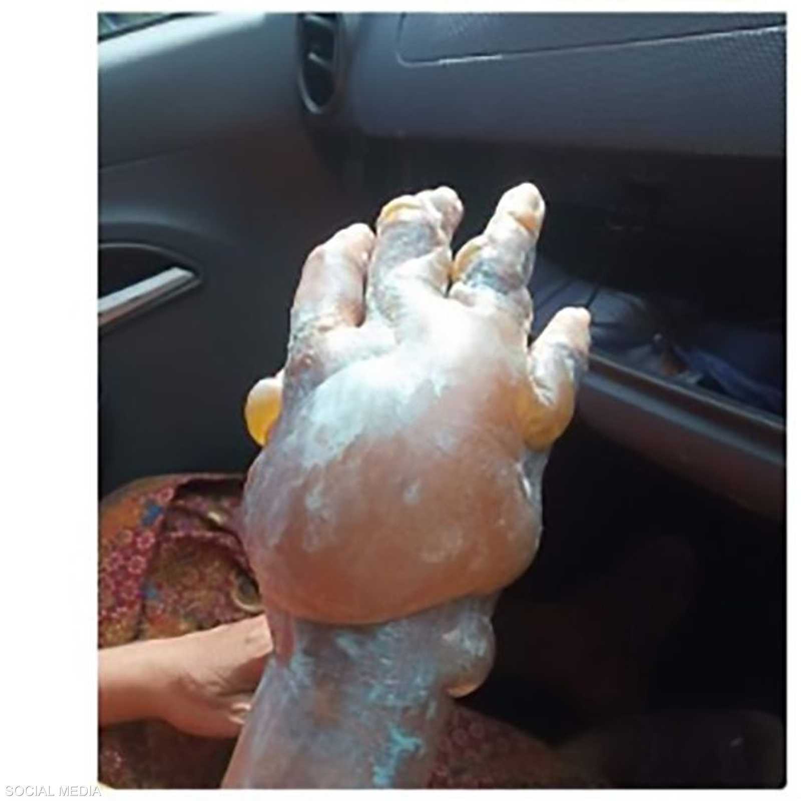 اليد تعرضت لمضاعفات خطيرة