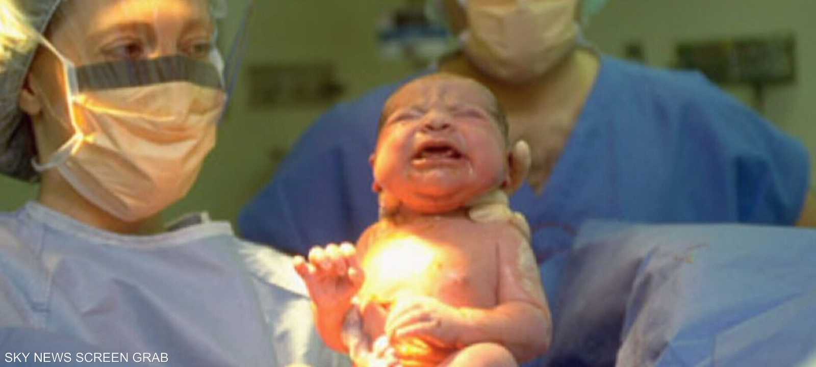 ارتفاع معدل الولادات القيصرية بالولايات المتحدة