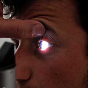 تحول لون بياض العين لدرجة مائلة للصفرة يستدعي الذهاب للطبيب