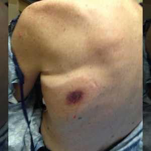 بعد أعراض البرد والقشعريرة ظهرت هذه البقعة على ظهر والدها