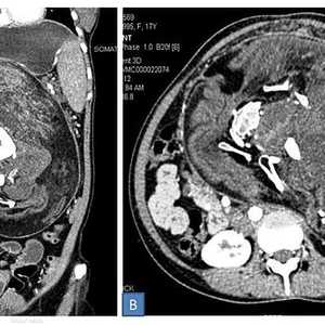 التصوير المقطعي أظهر وجود كتل دهنية وعظام وشعر