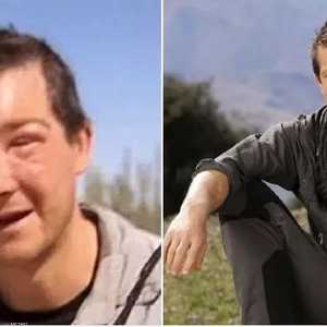 المغامر البريطاني قبل الإصابة وبعدها