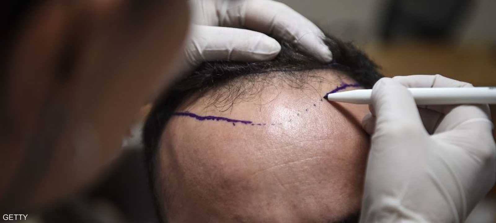 زراعة الشعر حل.. وليست علاجا للمشكلة