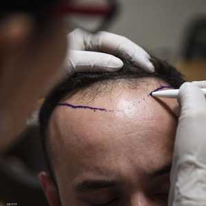 زراعة الشعر حل.. وليست علاجا للمشكلة