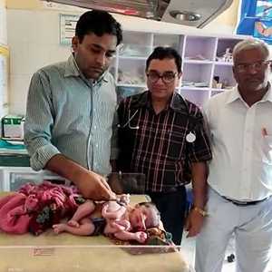 الطفلة التوأم مع الطاقم الطبي