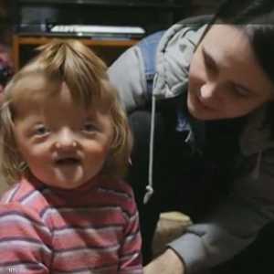 الطفلة صوفيا تعاني من تشوه في الجمجمة