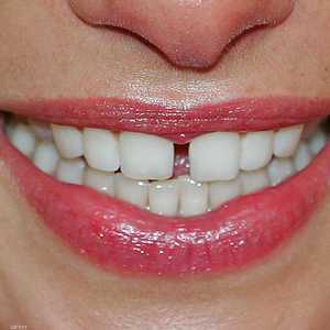 لا ينصح باستخدام بيكربونات الصوديوم لأكثر من 3 أيام أسبوعيا